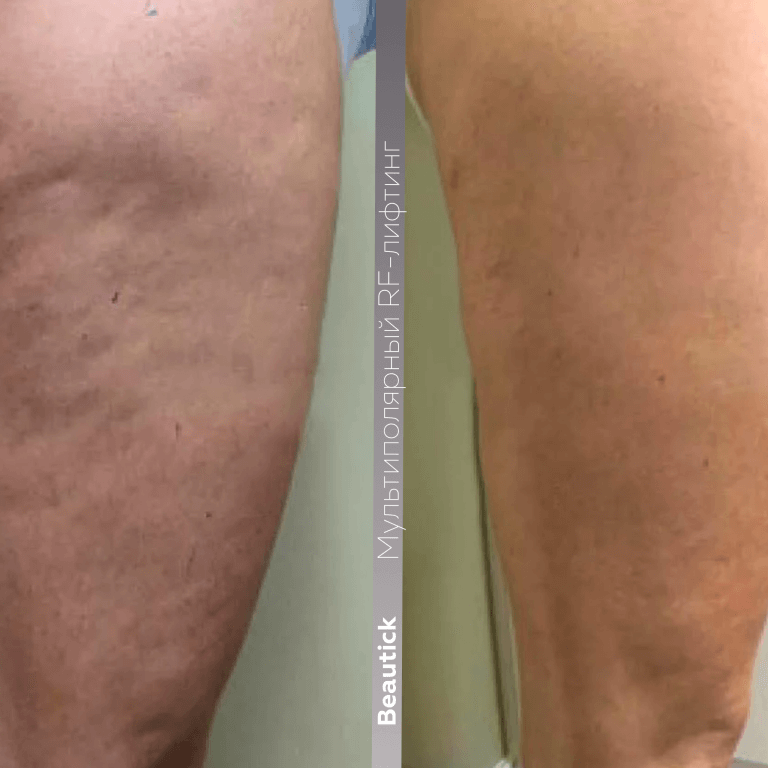 Мультиполярный RF лифтинг