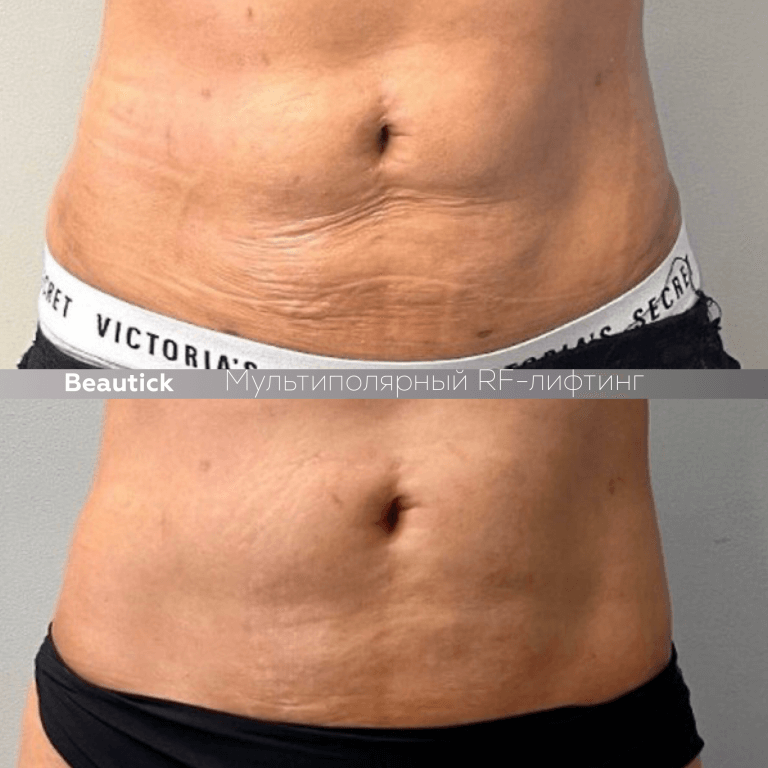 Мультиполярный RF лифтинг