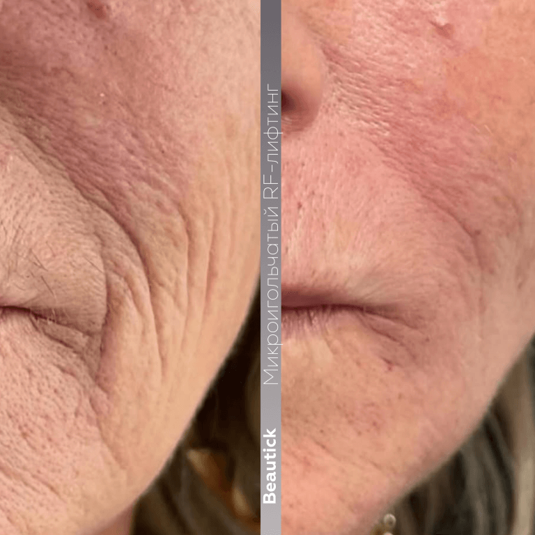 Аппаратная косметология