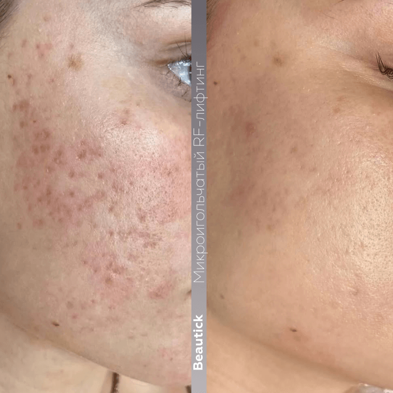 Микроигольчатый RF-лифтинг