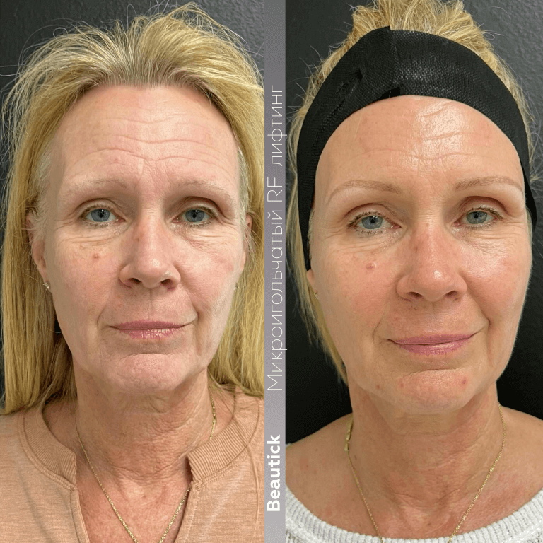 Аппаратная косметология