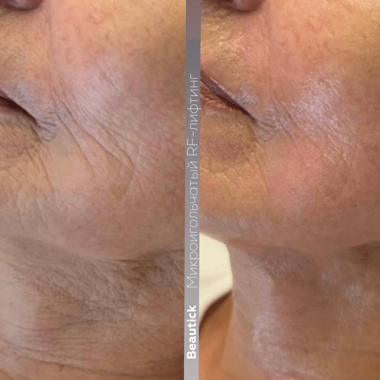 Аппаратная косметология