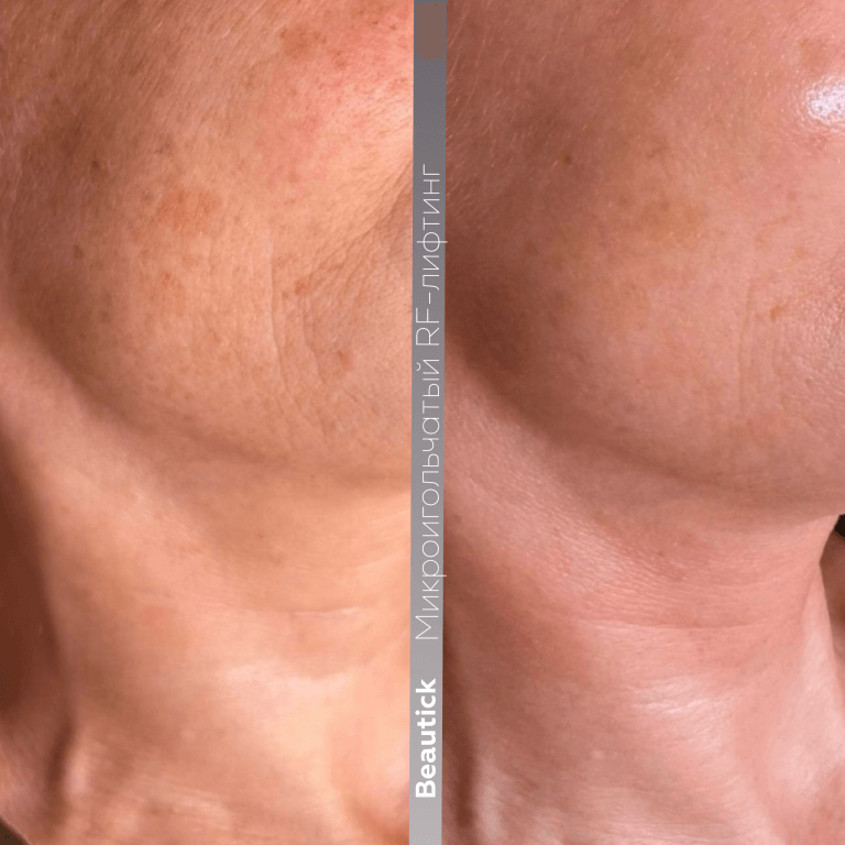 Микроигольчатый RF-лифтинг