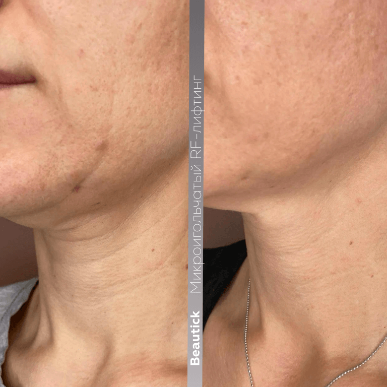 Микроигольчатый RF-лифтинг