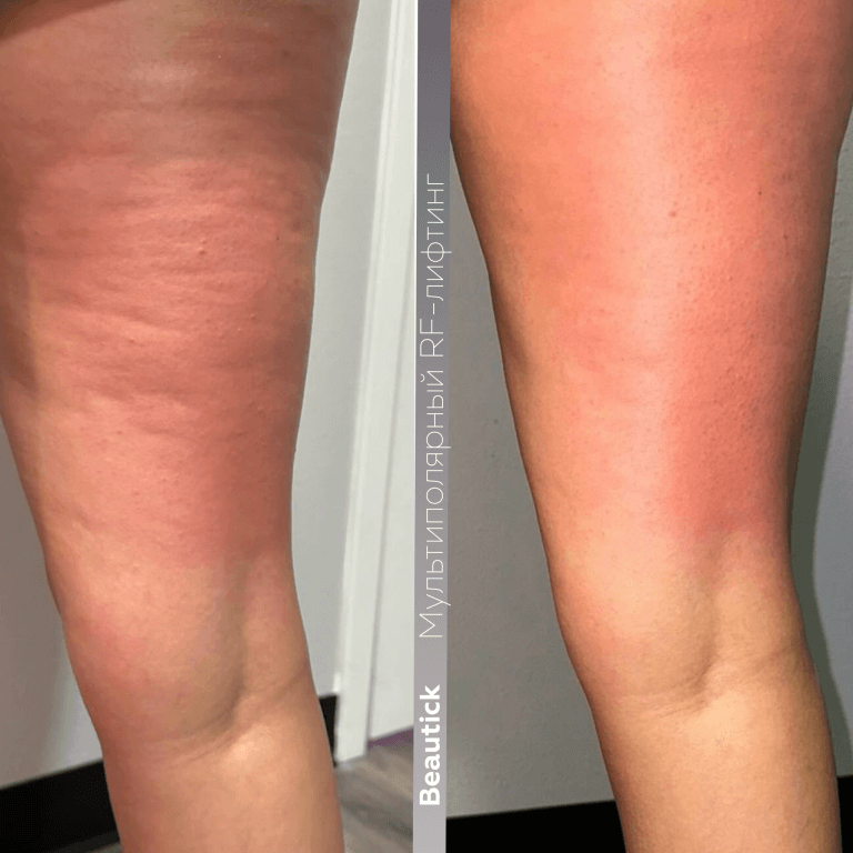 Аппаратная косметология