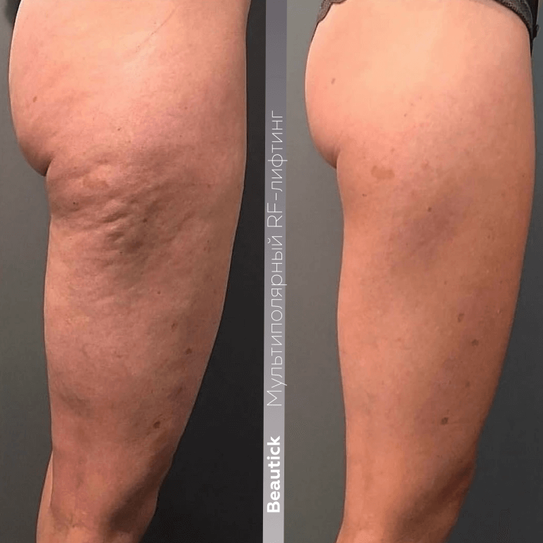 Аппаратная косметология