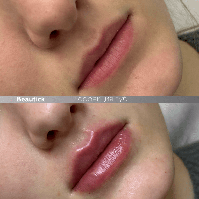 Инъекционная косметология