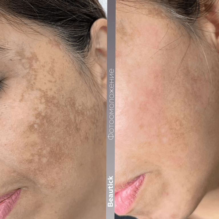 Фотоомоложение / Фотолечение IPL