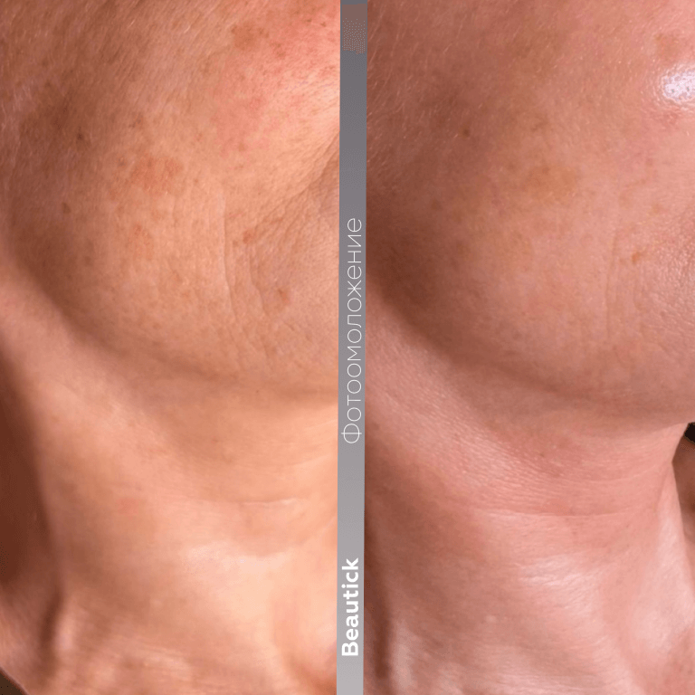 Фотоомоложение / Фотолечение IPL