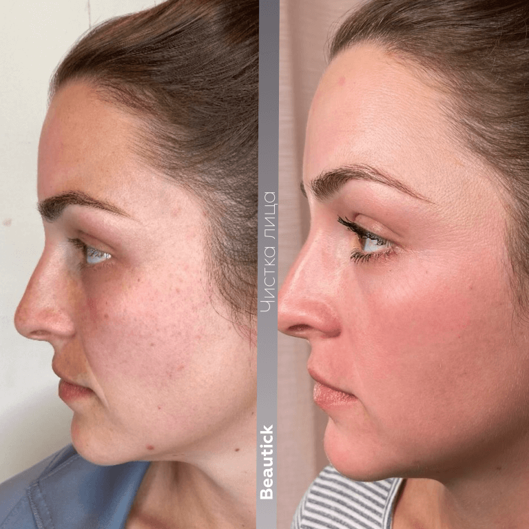 Чистка лица