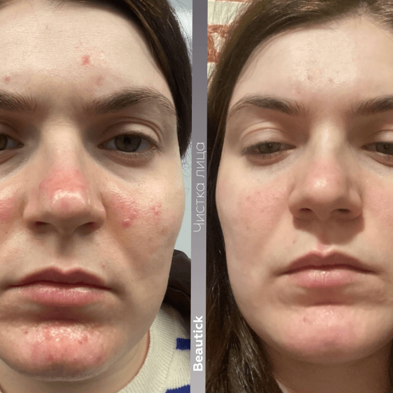 Чистка лица