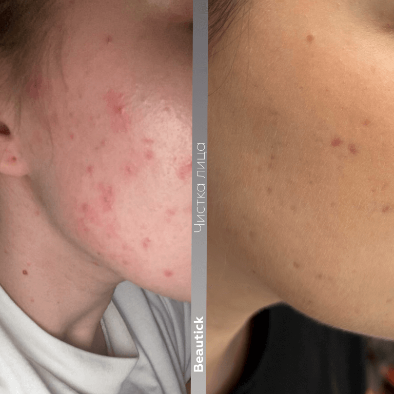 Чистка лица