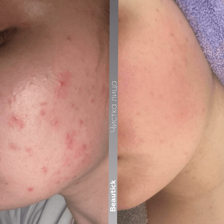 Чистка лица