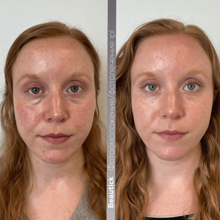Фотоомоложение / Фотолечение IPL