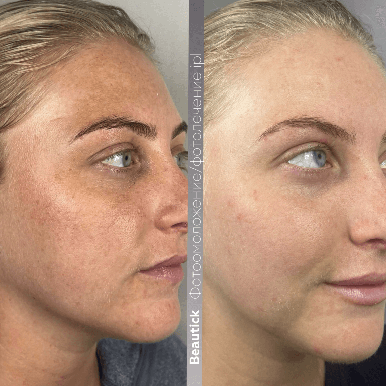 Фотоомоложение / Фотолечение IPL