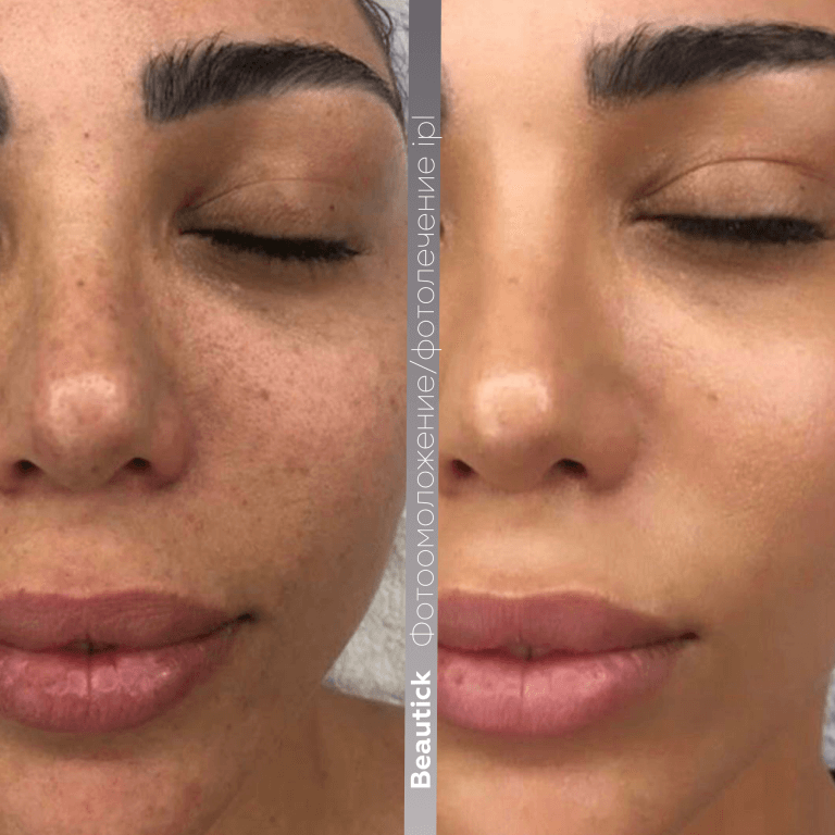 Аппаратная косметология