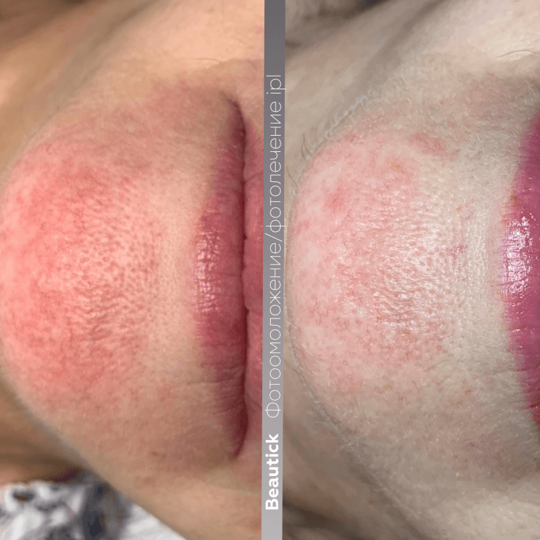 Фотоомоложение / Фотолечение IPL