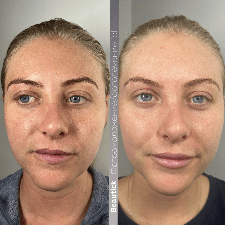 Аппаратная косметология