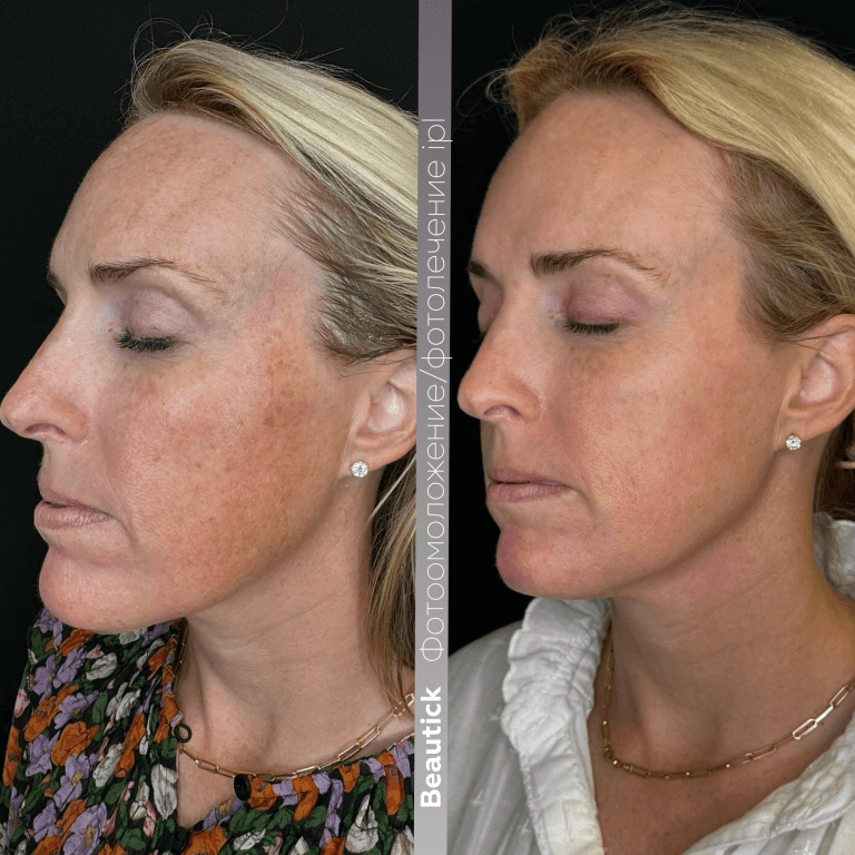 Фотоомоложение / Фотолечение IPL
