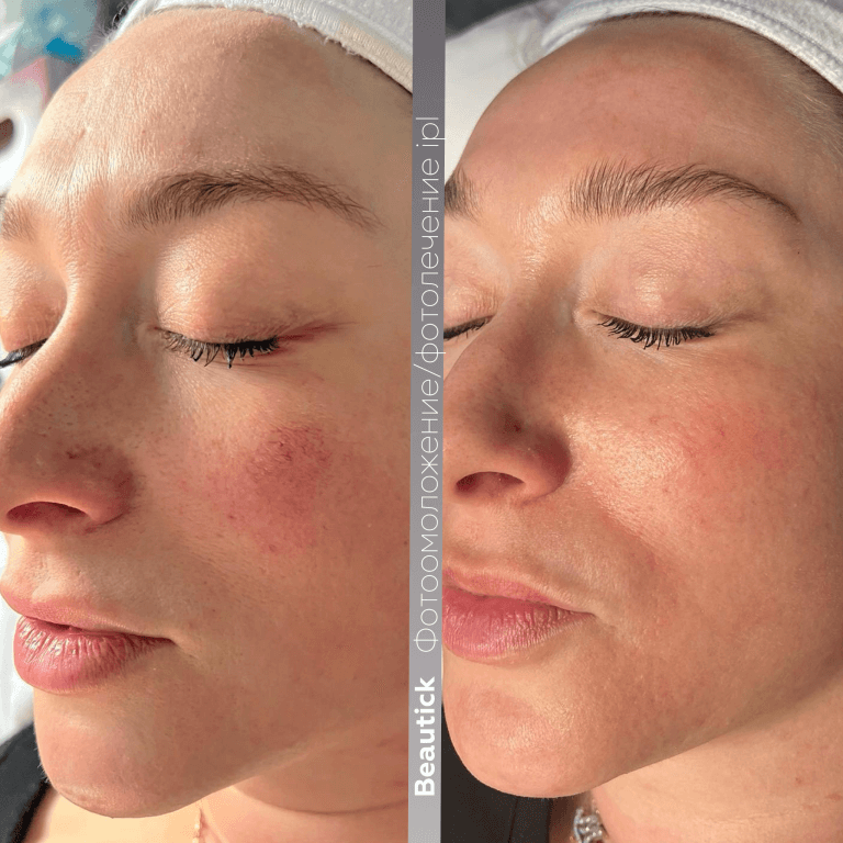 Фотоомоложение / Фотолечение IPL
