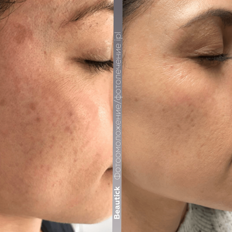 Фотоомоложение / Фотолечение IPL