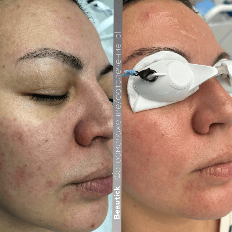 Аппаратная косметология