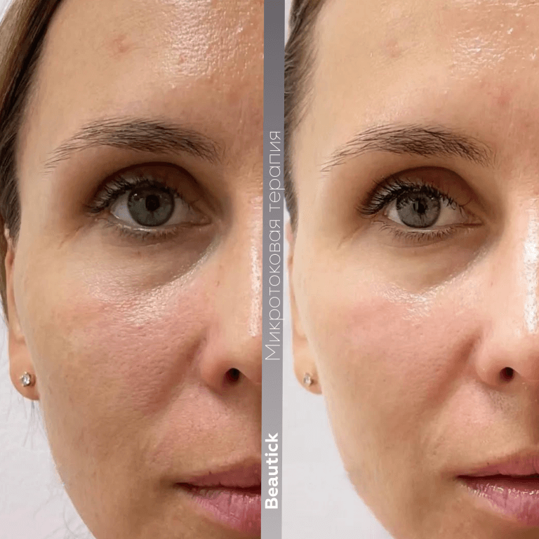 Микротоковая терапия