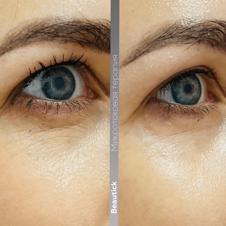 Микротоковая терапия