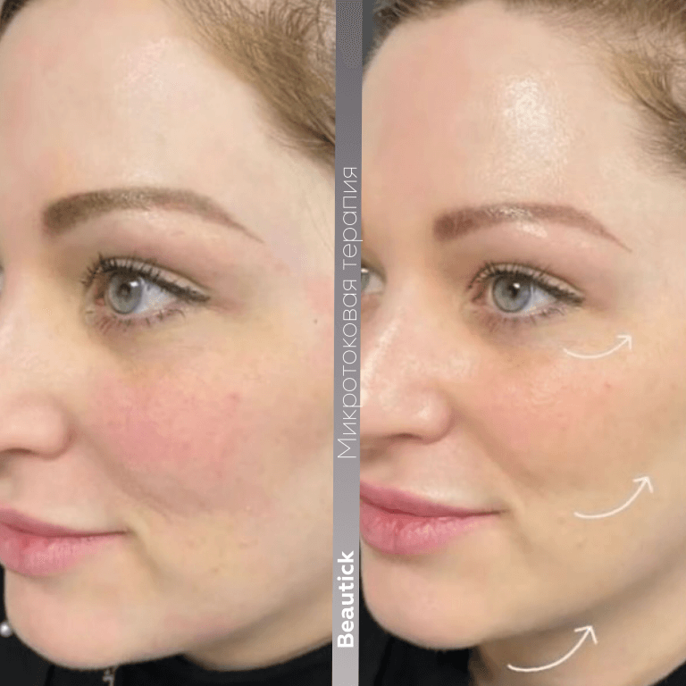 Микротоковая терапия