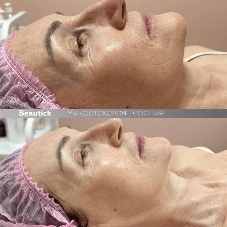 Микротоковая терапия