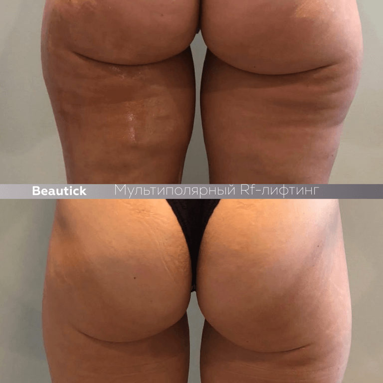 Мультиполярный RF лифтинг