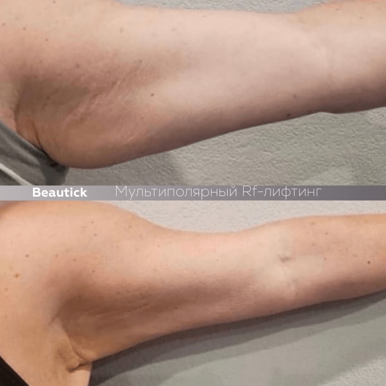 Мультиполярный RF лифтинг