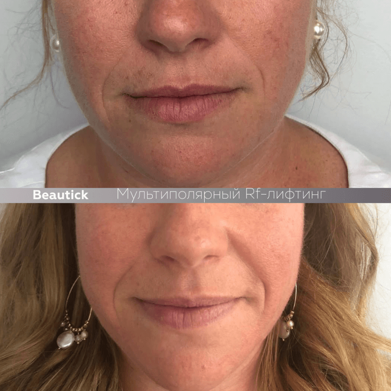 Мультиполярный RF лифтинг