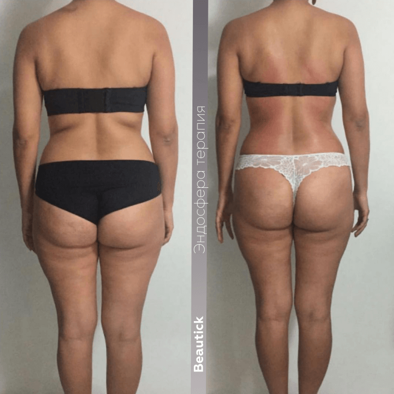 Эндосфера Терапия