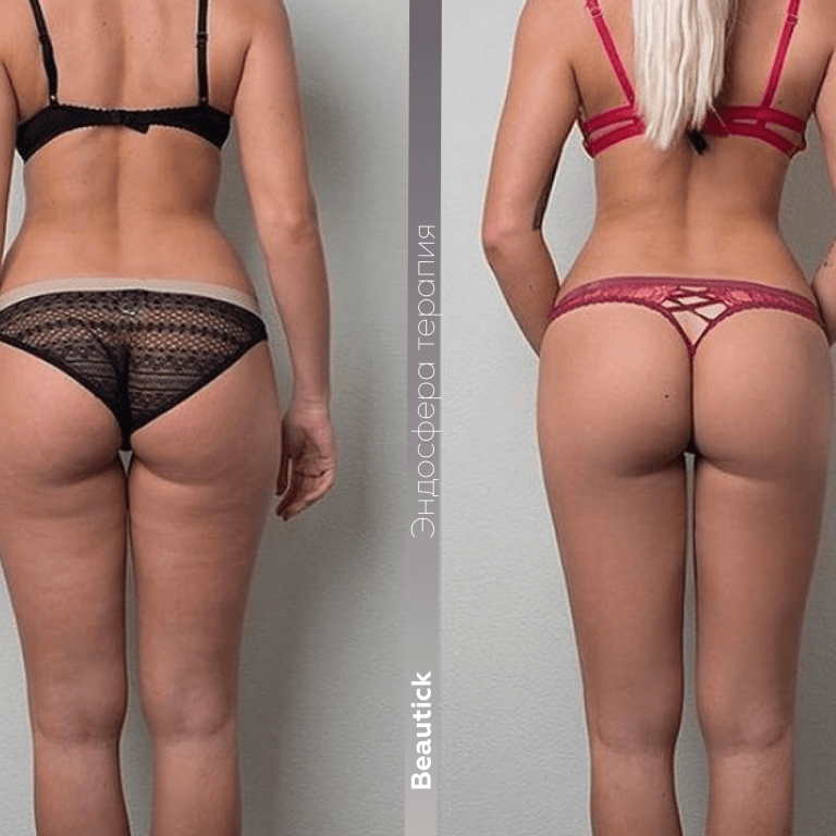 Эндосфера Терапия