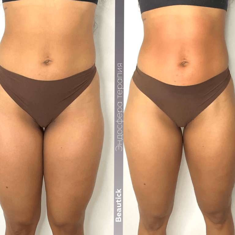 Эндосфера Терапия