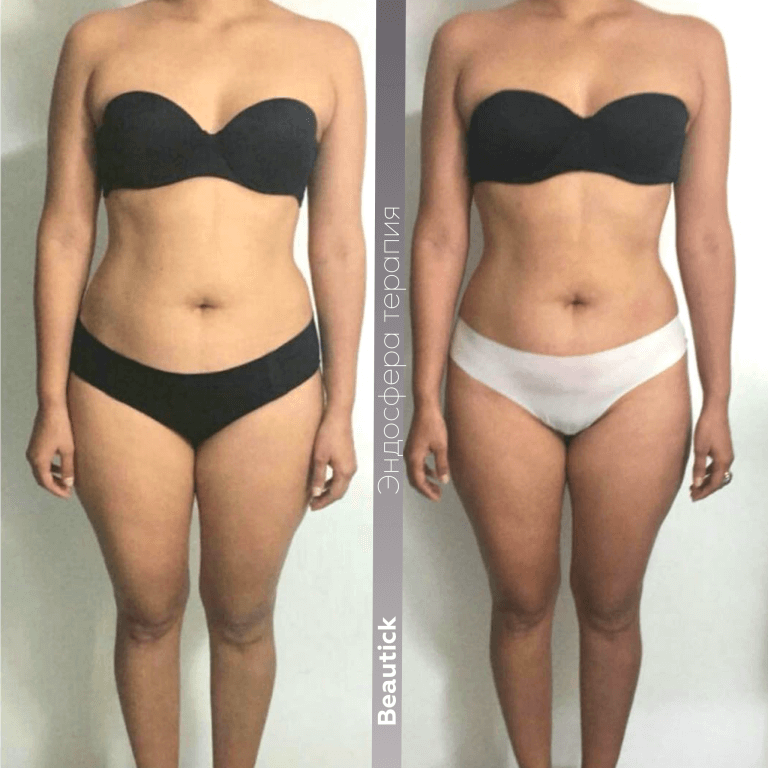 Эндосфера Терапия