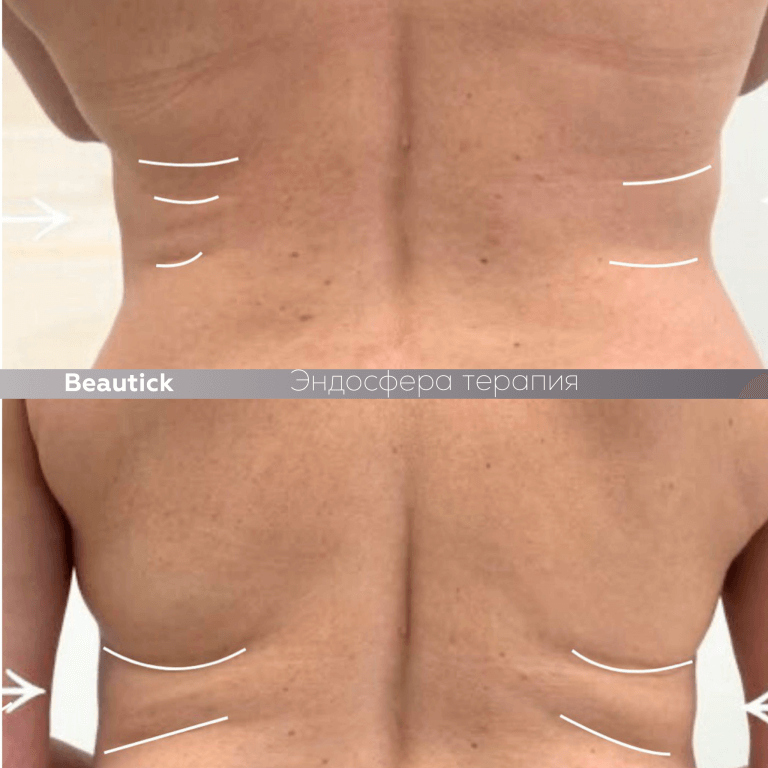 Эндосфера Терапия