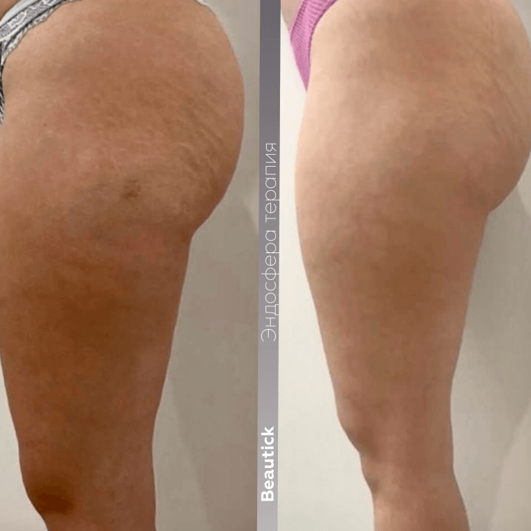 Эндосфера Терапия