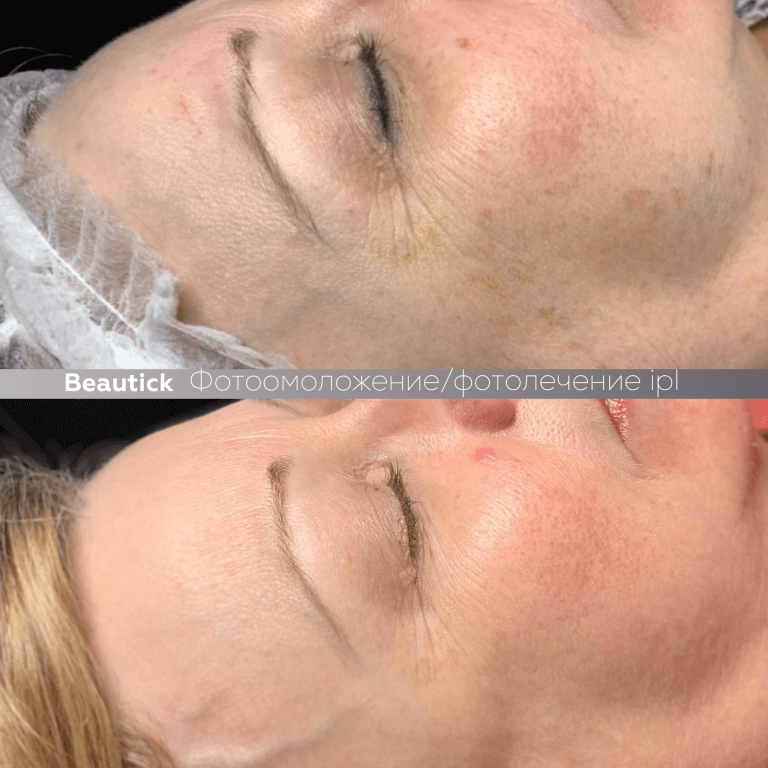 Фотоомоложение / Фотолечение IPL