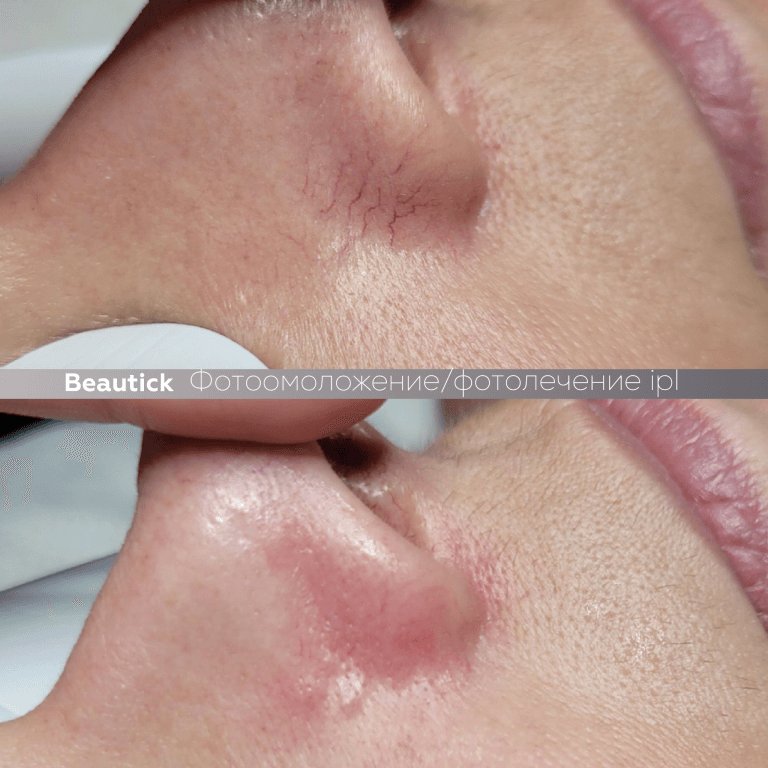 Фотоомоложение / Фотолечение IPL