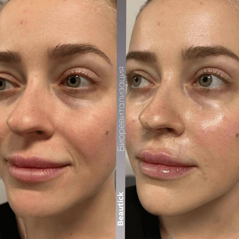 Инъекционная косметология