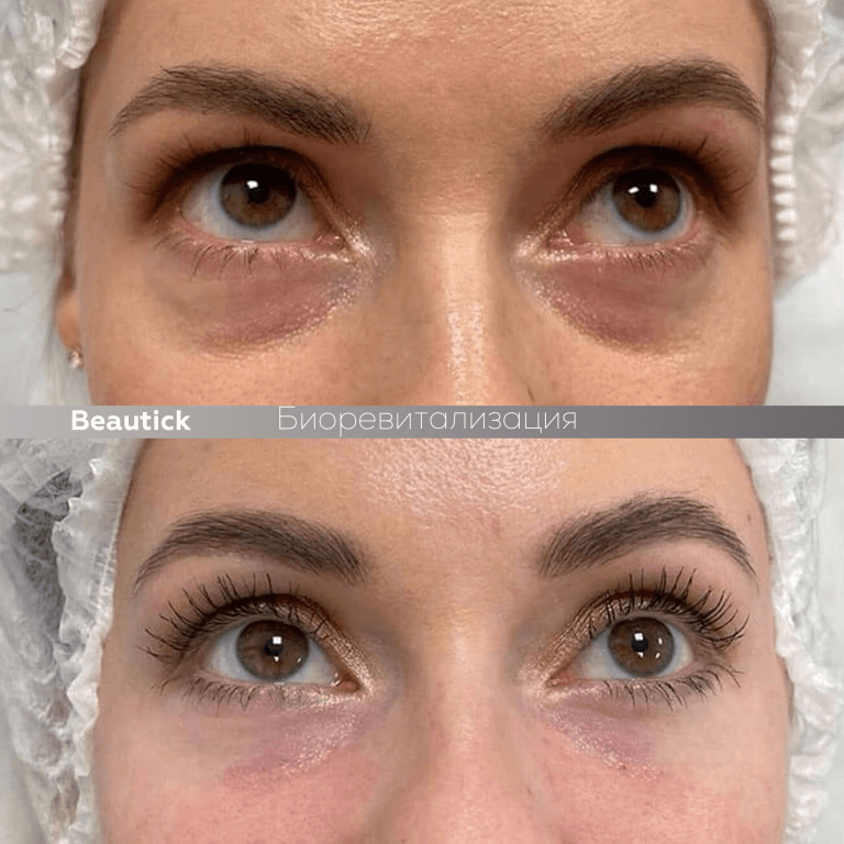 Биоревитализация