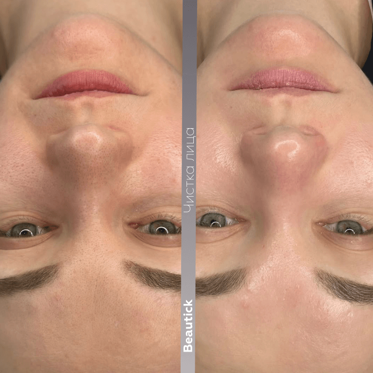 Чистка лица