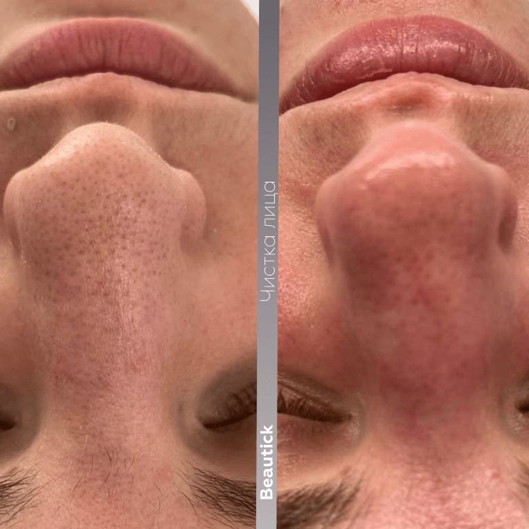 Чистка лица