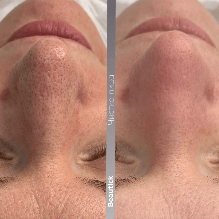 Чистка лица