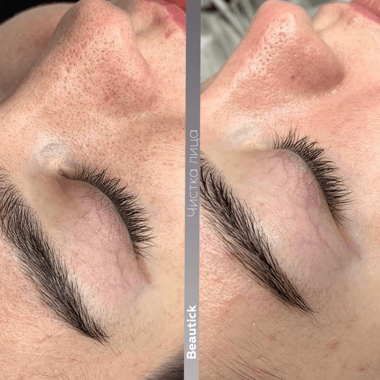 Чистка лица