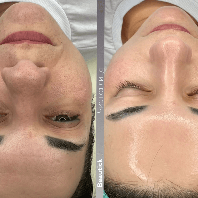 Чистка лица