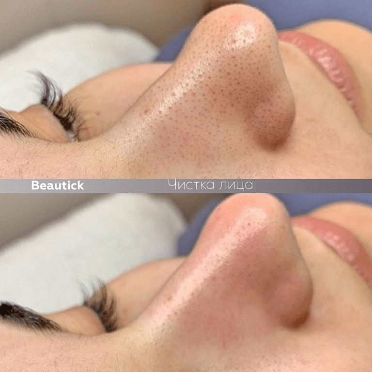 Чистка лица