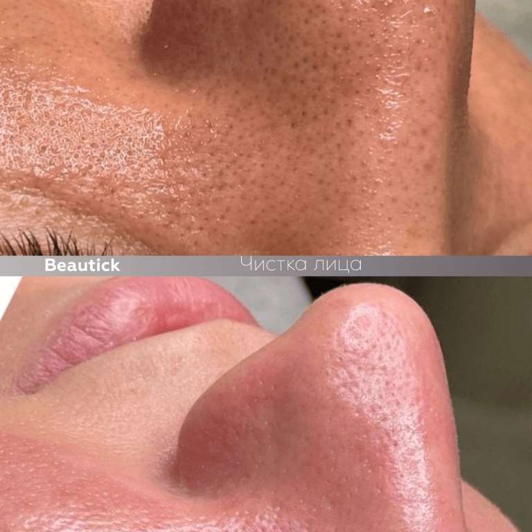 Чистка лица